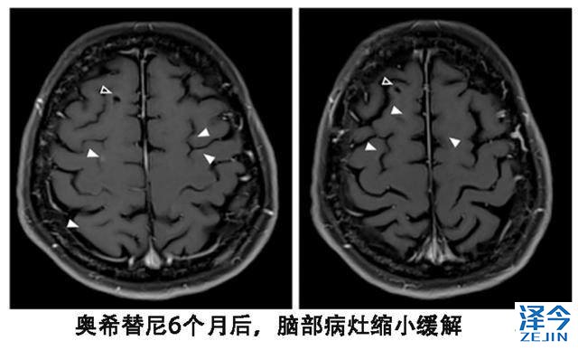泰瑞沙（AZD9291）