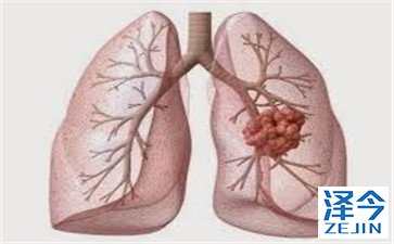 AZD9291可改善EGFR突变非小细胞肺癌患者的无进展生存期