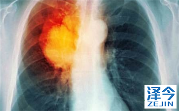 易瑞沙治疗肺癌的疗效