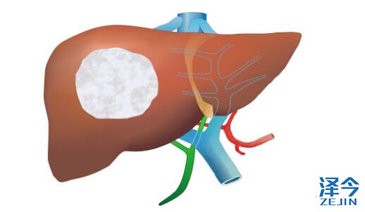 瑞戈非尼：肝癌治疗空白被填充
