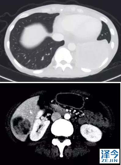 2019非小细胞肺癌患者将有哪些全新的治疗方案？