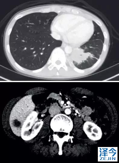 史上最全！肺癌靶点全面解读及对应靶向药物方案盘点！（2018）