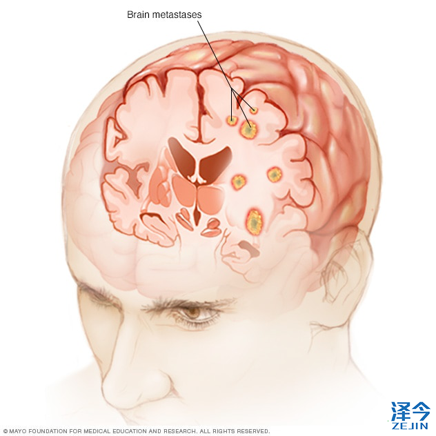 梅奥诊所肺癌脑转