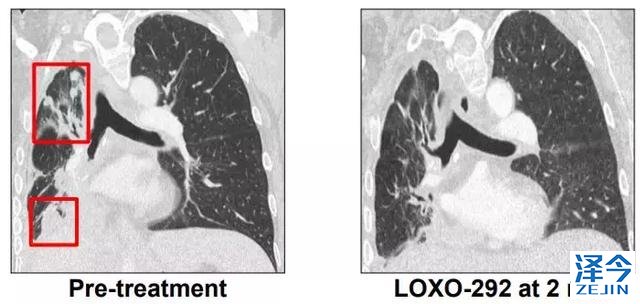 2018，两款重磅新药给RET基因融合的癌症患者带来春天！