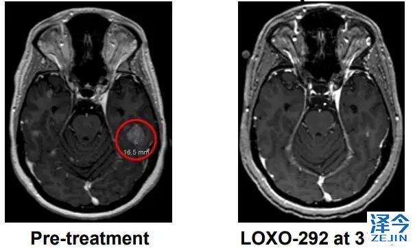 2018，两款重磅新药给RET基因融合的癌症患者带来春天！