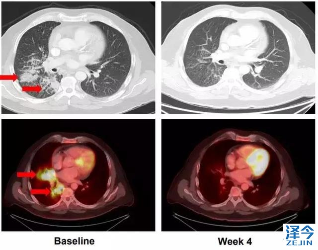 2018，两款重磅新药给RET基因融合的癌症患者带来春天！