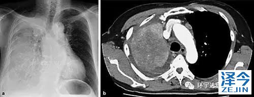 不可思议，肺腺癌患者吃了这种靶向药居然变成了小细胞肺癌！