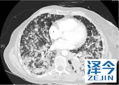 2019非小细胞肺癌患者将有哪些全新的治疗方案？