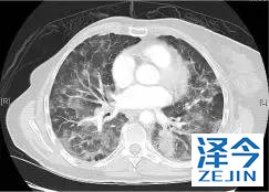 2019非小细胞肺癌患者将有哪些全新的治疗方案？