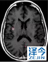 2019非小细胞肺癌患者将有哪些全新的治疗方案？