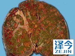 乐伐替尼经FDA批准用于治疗分化型甲状腺癌患者