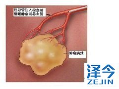 乐伐替尼在间变性甲状腺癌中表现出抗肿瘤活性
