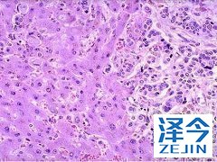 乐伐替尼治疗甲状腺癌中肿瘤大小变化的表征