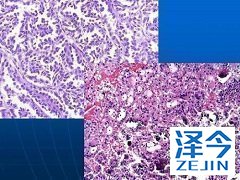 乐伐替尼是治疗晚期肝癌的潜在突破？