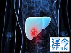 乐伐替尼治疗肝癌效果不低于索拉非尼