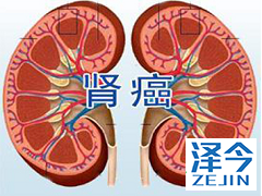 抗癌药物乐伐替尼能用于肾癌的治疗吗？