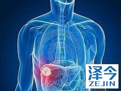 乐伐替尼治疗我国患者效果优于欧美国家！