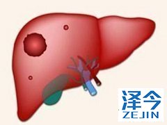 乐伐替尼对肝癌疗效显著