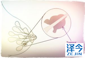 帕博西尼（Palbociclib） 独辟蹊径治疗乳腺癌