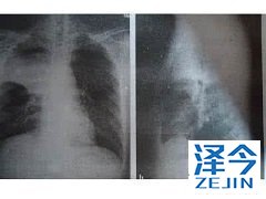 奥希替尼在老年非小细胞肺癌患者中的试验