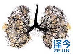 奥希替尼治疗间质性肺病后晚期非小细胞肺癌