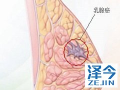患者使用来那替尼能改善预后 