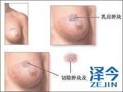 来那替尼被批准用于扩展辅助治疗手段使用