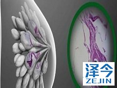 来那替尼可延乳腺癌患者的侵袭性疾病