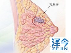 来那替尼能够降低早期HER2阳性乳腺癌患者的复发率 