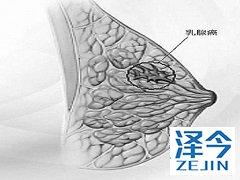 来那替尼仅对HER2阳性乳腺癌的患者明显