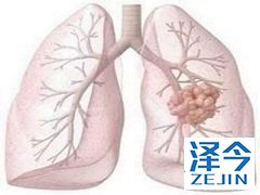 布加替尼预后明显优于克唑替尼 