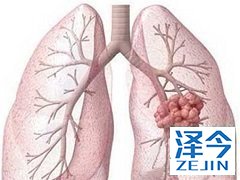 布加替尼有希望治疗奥斯替尼耐药患者