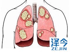 布加替尼对于肝癌的抑制作用如何