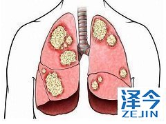 布加替尼联合抗EGFR抗体克服奥希替尼耐药性