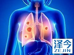 布加替尼能够为脑转移患者提供治疗效果吗