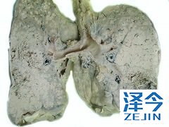 布加替尼在淋巴瘤中的治疗功效和抗性机制