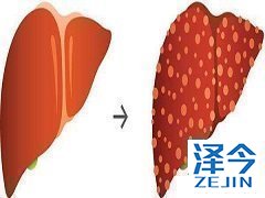 吉三代与利巴韦林治疗丙型肝炎病毒患者