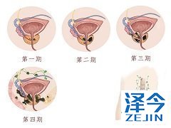 如何服用阿比特龙？
