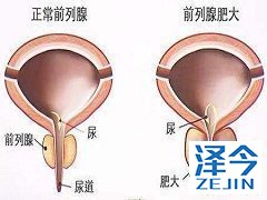 捣碎阿比特龙再服用会影响最终的治疗效果