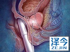 阿比特龙联合治疗前列腺癌有效果吗？