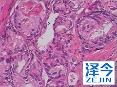 阿比特龙治疗患者生存率可显著改善