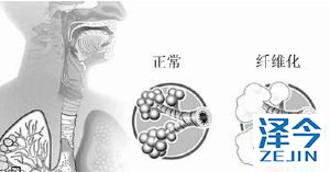 尼达尼布登陆中国，肺纤维化患者还是选择海外买