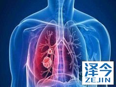 尼达尼布 能够阻止肿瘤新血管生成