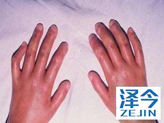 尼达尼布作为硬皮病潜在治疗方案获得FDA审批