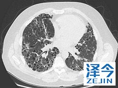 除了肺癌尼达尼布还可以什么疾病？