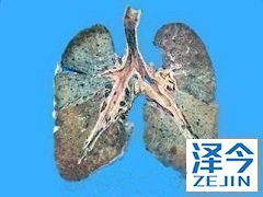 肺纤维化患者能够使用尼达尼布吗？