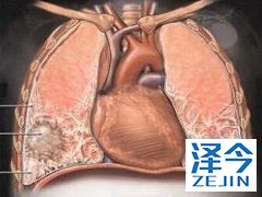 中重度患者更适合使用尼达尼布尽心治疗