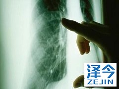 使用尼达尼布作为肺腺癌二线治疗效果好吗?