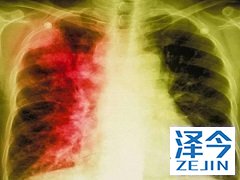 靶向药尼达尼布国内患者带来更多的治疗选择