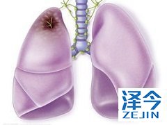 尼达尼布美国上市实验为中国患者的使用提供参考